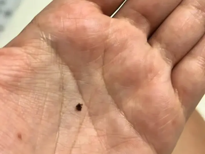 Garrapata sobre la palma de una mano, hallada durante un servicio